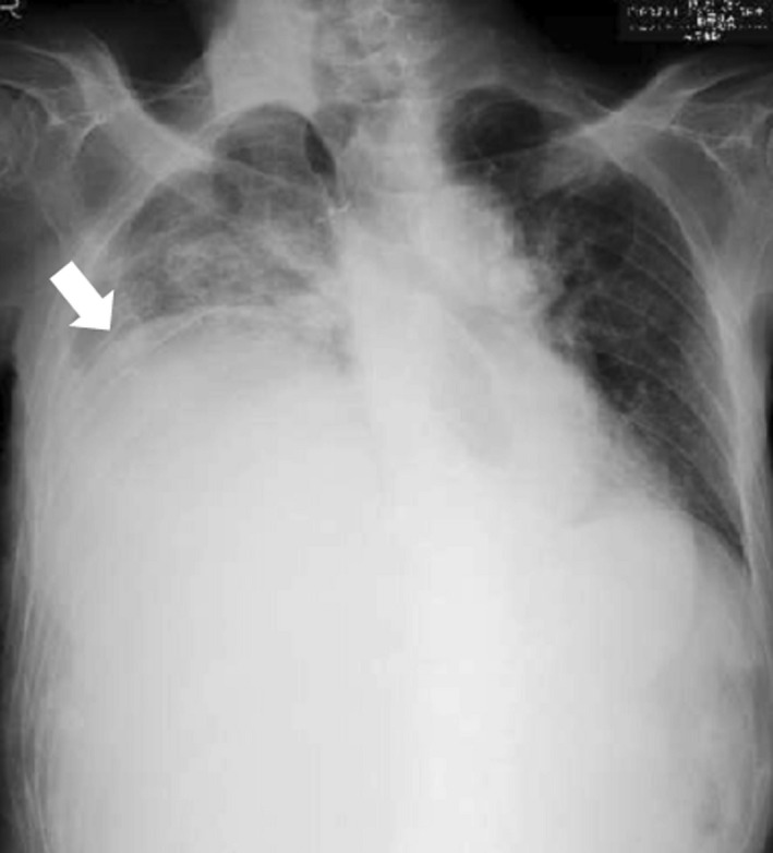 Giant Hepatic Cyst Causing Lower Extremity Edema And Scoliosis - Pmc