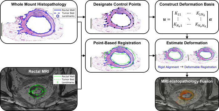 Coregistration workflow for the proposed linearized iterative boundary reconstruction (LIBR) MRI-histopathology fusion method after segmentation and landmark characterization as demonstrated in Figure 2. Prior to coregistration, eight point-based landmarks are annotated on the external and internal rectal contours on each MR and whole-mount histopathology (WMH) image. A series of regularized Kelvinlet control points is then distributed across the external and internal rectal contours, from which a biomechanical deformation basis is constructed. After point-based registration of landmarks, deformation of the histopathology sample relative to MRI is computed from the rectal wall contours via the LIBR approach. A series of control points are distributed across the external and internal rectal contours to establish a regularized Kelvinlet deformation basis for the WMH image. The LIBR approach estimates the deformation between WMH and MRI by maximizing the agreement between rectal wall contours subject to this deformation basis. Finally, the registered WMH is fused with MRI to indicate spatial correspondence between reference standard histopathologic features and MRI.