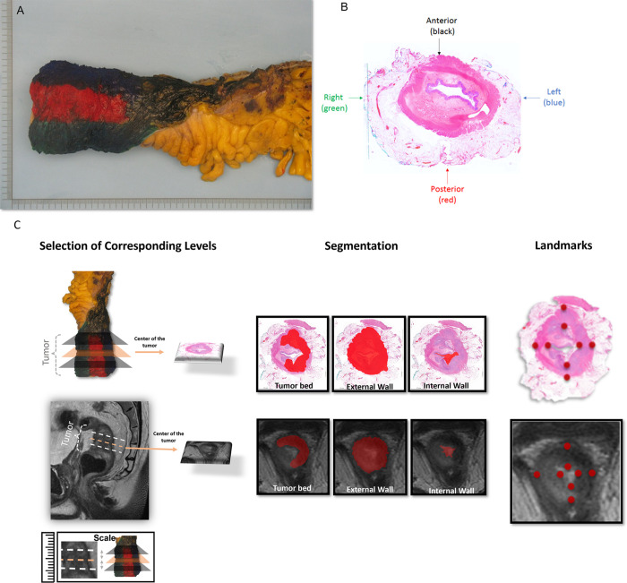 Demarcation of a standard total mesorectal excision specimen on (A, B) surgical and whole-mount histology (WMH) slices and (C) radiology-pathology workflow of segmentation and landmark definition. (A) Circumferential margins of the rectal cancer resection specimen were marked with different ink colors to distinguish anterior and posterior and right and left regions of the specimen and enable proper orientation. (B) WMH slice of the total mesorectal excision specimen demonstrates the color code that was used to guide the spatial localization of the rectum portions, as follows: black = anterior, red = posterior, blue = left, and green = right. (C) A gastrointestinal pathologist and a radiologist conducted a collaborative review of WMH and MR images to ensure precise correspondence between pathology and high-resolution T2-weighted imaging. Three corresponding levels were established for each patient at WMH and MRI: the midpoint of the tumor bed, one slice or section above, and one slice or section below. Subsequently, both experts manually delineated the external rectal contour (the outer edge of the muscularis propria), internal rectal contour (inner aspect of the mucosa), and tumor bed at each designated level (illustrated at the midpoint level). Additionally, the radiologist and pathologist annotated eight corresponding point-based landmarks in each modality along the internal and external borders of the rectal wall, encompassing the anterior, posterior, leftward, and rightward directions.