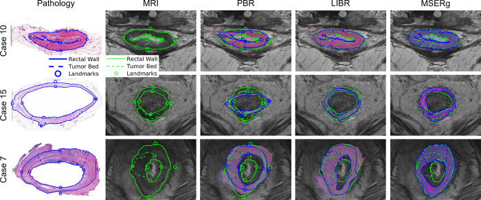 Visualization of the alignment quality achieved by each coregistration method. Restaging MR–whole-mount histology image fusion is shown in three representative cases. Case 10 (a 43-year-old female patient), case 15 (a 65-year-old male patient), and case 7 (a 47-year-old male patient) represent cases with the best Dice similarity coefficient, average Dice similarity coefficient, and worst Dice similarity coefficient, respectively. Between the investigated linearized iterative boundary reconstruction (LIBR), rigid point-based registration (PBR), and multiscale spectral embedding registration (MSERg) methods, LIBR produced better alignment. Note that in case 7, MSERg produced a misalignment of approximately 90° between the pathology slice and the MR image.