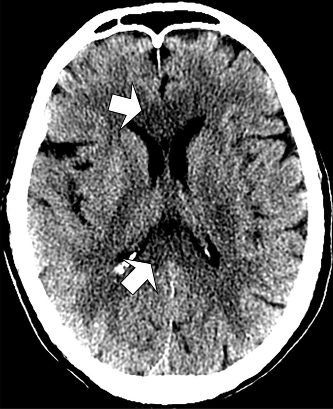 Unenhanced CT image of head demonstrates confluent hypoattenuation in genu (anterior) and splenium (posterior) of corpus callosum (arrows).