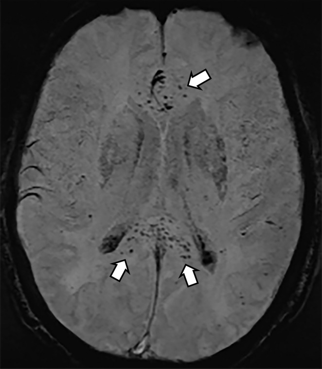 (a) T2-weighted fluid-attenuated inversion recovery MRI scan of brain shows extensive posterior greater than anterior white matter hyperintensity (arrows) without mass effect. (b) Susceptibility-weighted image demonstrates a cluster of microhemorrhages in corpus callosum (arrows). (c) Arterial-spin-labeling perfusion images are suggestive of posterior circulation hyperperfusion (arrows). CBF = cerebral blood flow.