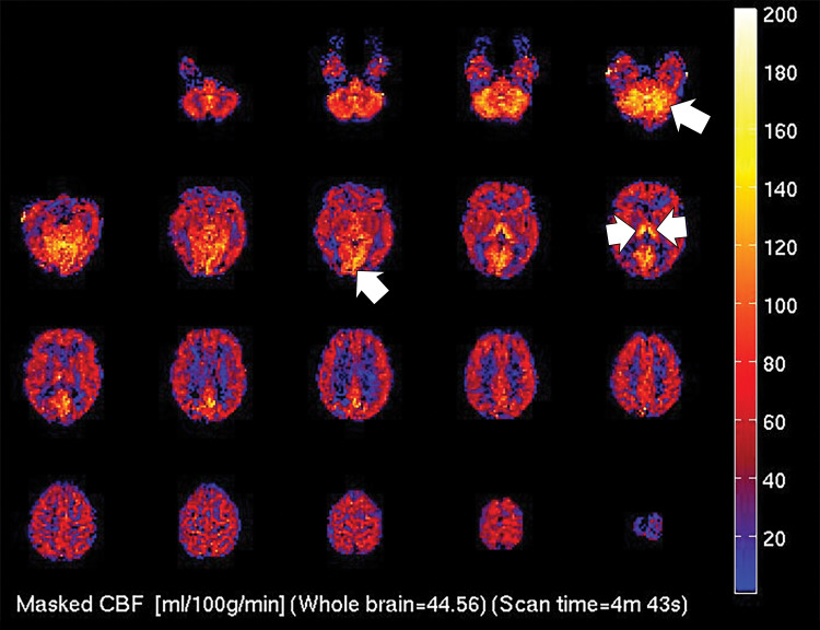 (a) T2-weighted fluid-attenuated inversion recovery MRI scan of brain shows extensive posterior greater than anterior white matter hyperintensity (arrows) without mass effect. (b) Susceptibility-weighted image demonstrates a cluster of microhemorrhages in corpus callosum (arrows). (c) Arterial-spin-labeling perfusion images are suggestive of posterior circulation hyperperfusion (arrows). CBF = cerebral blood flow.