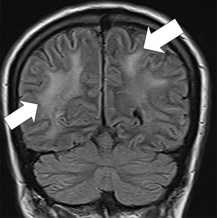 (a) T2-weighted fluid-attenuated inversion recovery MRI scan of brain shows extensive posterior greater than anterior white matter hyperintensity (arrows) without mass effect. (b) Susceptibility-weighted image demonstrates a cluster of microhemorrhages in corpus callosum (arrows). (c) Arterial-spin-labeling perfusion images are suggestive of posterior circulation hyperperfusion (arrows). CBF = cerebral blood flow.