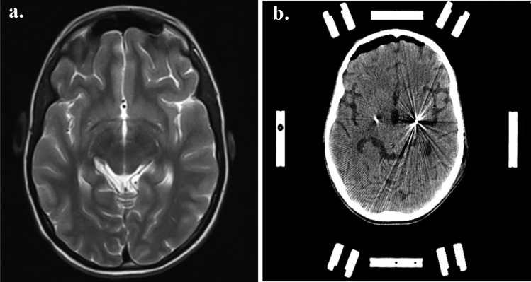 DBS emergency surgery for treatment of dystonic storm associated with ...