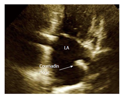 Coumadin ridge: An incidental finding of a left atrial pseudotumor on ...