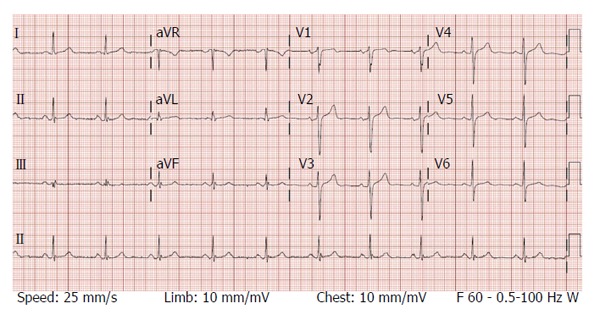 Coumadin ridge: An incidental finding of a left atrial pseudotumor on ...