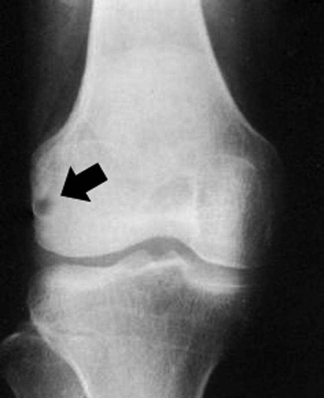 Tuberculosis of the Knee: A Case Report and Literature Review - PMC