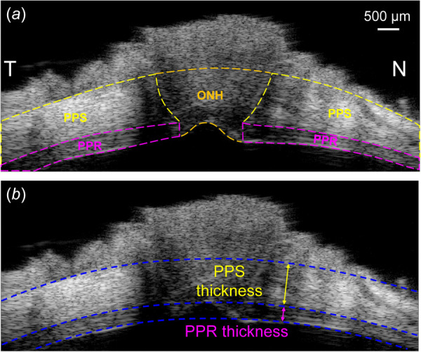 (a) A representative ultrasound image of the scanned region along the nasal-temporal (NT) axis. PPR, ONH, and PPS are manually segmented. (b) Circle fitting of the posterior PPS, posterior PPR, and anterior PPR boundaries. PPR and PPS thicknesses are calculated as the difference in radii between adjacent circles.