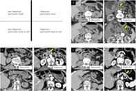 Diffuse pancreatic parenchymal atrophy, an imaging finding predictive ...