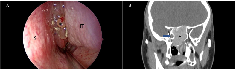 Allergic Fungal Rhinosinusitis Presented As A Unilateral Nasal Mass: A 