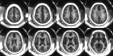 Representative three-dimensional short repetition time (TR) adiabatic inversion recovery prepared ultrashort echo time images in same volunteer as in Figure 4 with TR of 140 msec and inversion time of 61 msec demonstrate volumetric myelin imaging of whole brain.