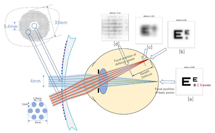 Overview on Defocus Incorporated Multiple Segments Lenses: A Novel ...