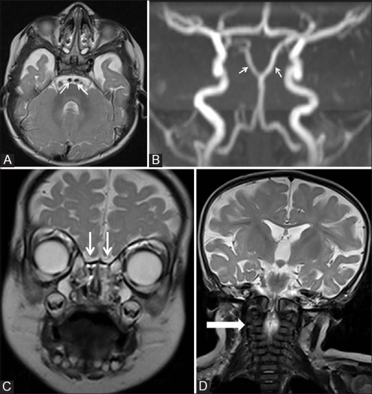 Duplication Of The Pituitary Gland Plus Syndrome Pmc