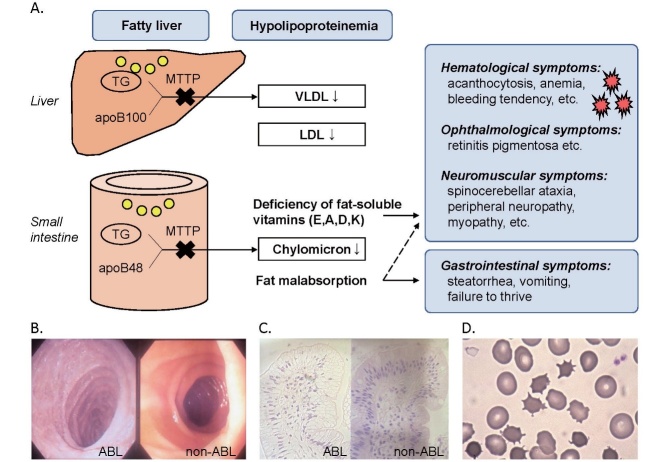 Fig.1. Overview of abetalipoproteinemia