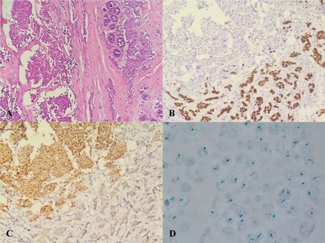 Cytoplasmic Her2/neu Immunohistochemical Staining in Breast Cancer ...