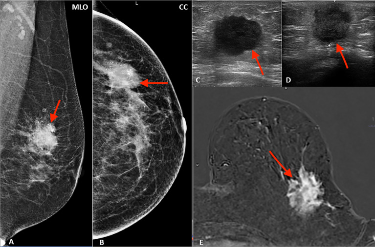 Multimodality Imaging In Lobular Breast Cancer Differences In