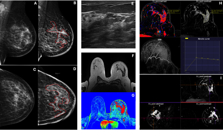 Multimodality Imaging In Lobular Breast Cancer Differences In