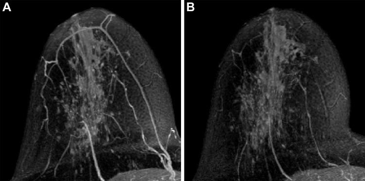 Axial maximum intensity projection of subtracted early contrast-enhanced phase MRI in right breast of a 55-year-old postmenopausal woman with left hormone receptor–positive human epidermal growth factor 2–negative invasive breast cancer at (A) T0 and (B) T2. The calculated background parenchymal enhancement (BPE) values were (A) 32.3% and (B) 35.0%, and the BPE change was evaluated as nonsuppressed (percent change of BPE at T2, ≥0). The patient was confirmed at pathologic analysis as having noncomplete response in the surgical specimen after neoadjuvant chemotherapy.