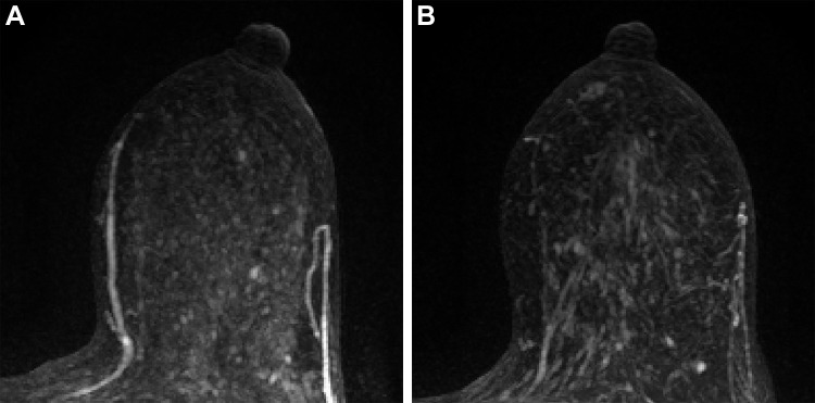 Axial maximum intensity projection of subtracted early contrast-enhanced phase MRI in left breast of a 50-year-old premenopausal woman with right hormone receptor–positive human epidermal growth factor 2–negative invasive breast cancer at (A) T0 and (B) T3. The calculated background parenchymal enhancement (BPE) values were (A) 20.5% and (B) 22.0%, and the BPE change was evaluated as nonsuppressed BPE (percent change of BPE at T3, ≥0). The patient was confirmed at pathologic analysis as having noncomplete response in the surgical specimen after neoadjuvant chemotherapy.