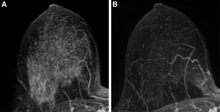 Axial maximum intensity projection of subtracted early contrast-enhanced phase MRI in right breast of a 47-year-old perimenopausal woman with left hormone receptor–positive human epidermal growth factor 2–negative invasive breast cancer at (A) T0 and (B) T2. The calculated background parenchymal enhancement (BPE) values were (A) 46.3% and (B) 15.9%, and the BPE change was evaluated as suppressed (percent change of BPE at T2, <0). The patient was confirmed at pathologic analysis as having complete response in the surgical specimen after neoadjuvant chemotherapy.