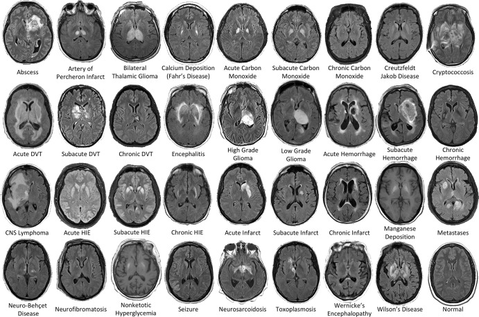 Examples of the 36 diagnostic entities included the study. All MRI scans are axial T2-weighted fluid-attenuated inversion recovery images except for manganese deposition and nonketotic hyperglycemia scans, which are T1-weighted images. CNS = central nervous system, DVT = deep vein thrombosis, HIE = hypoxic-ischemic encephalopathy.