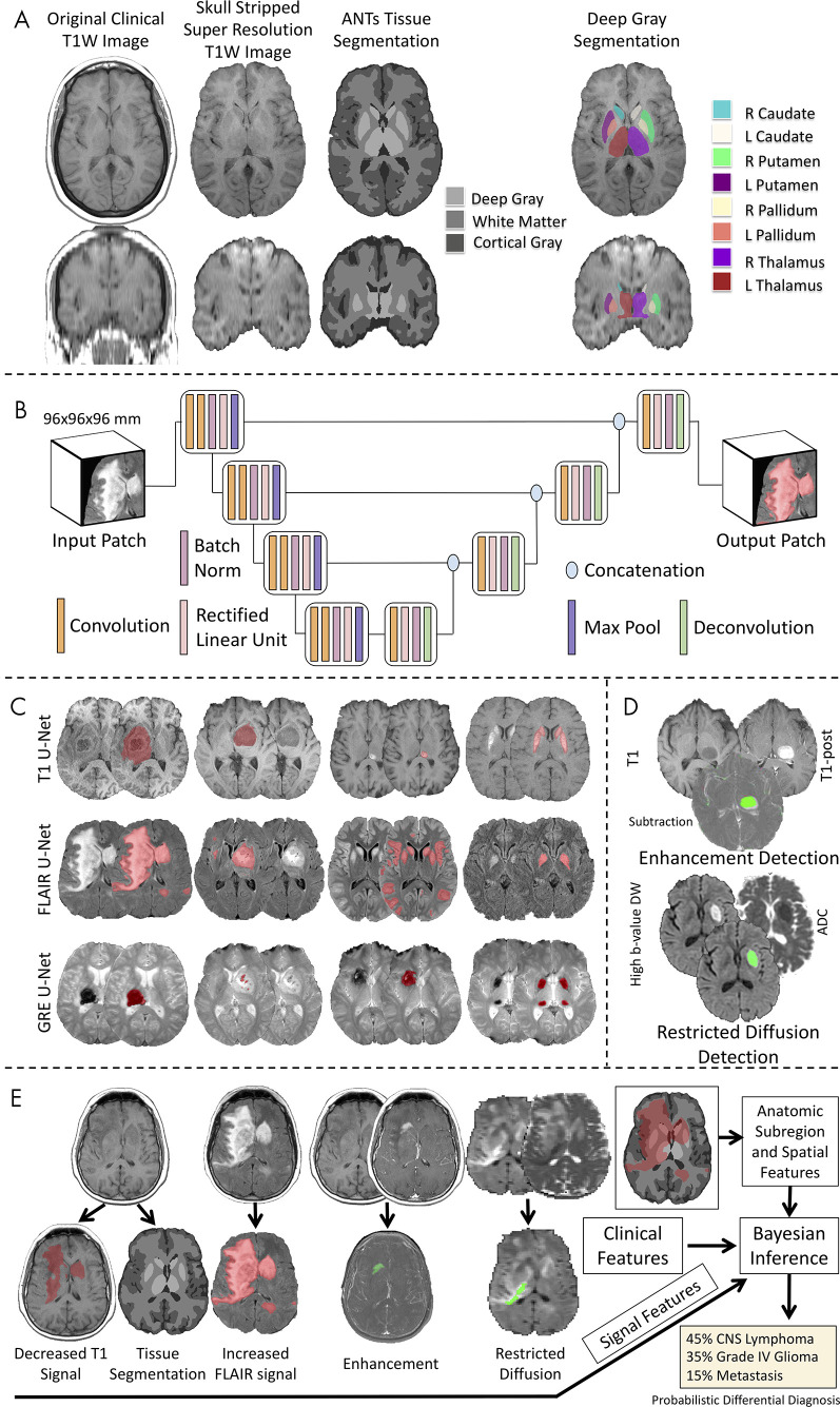 Workflow of the image processing pipeline. A, Atlas-based neuroimaging processing pipeline for tissue segmentation and deep gray matter parcellation. T1-weighted (T1W) axial (upper row) and coronal (lower row) MRI scans were up-sampled and skull-stripped (second column) before tissue segmentation with the Advanced Normalization Tools (ANTs) pipeline (third column) and parcellation of deep gray matter structures (fourth column). B, Diagrammatic overview of the custom three-dimensional U-Net architecture for abnormal signal detection. C, Examples of U-Net–based segmentations for T1-weighted (T1, first row), T2-weighted fluid-attenuated inversion recovery (FLAIR, second row), and gradient-recalled echo (GRE, third row) MRI scans of test case. D, Example of T1-weighted (T1), T1-weighted postcontrast (T1-post), and a subtraction of the T1-weighted image from the T1-weighted postcontrast image with detected areas of abnormal enhancement (green) and high b value diffusion-weighted (DW) and apparent diffusion coefficient (ADC) images with detected areas of restricted diffusion (green). E, Example of correctly diagnosed central nervous system (CNS) lymphoma processed through the full pipeline with signal, anatomic subregion, and spatial features (derived from abnormal signal segmentations overlaid on tissue segmentation maps) combined with clinical features into a Bayesian inference system to derive a probabilistic differential diagnosis.