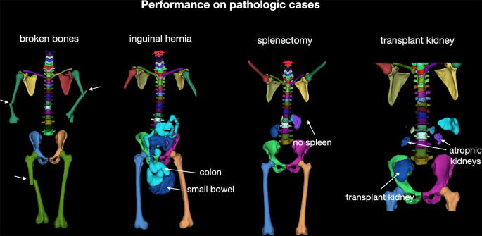 Overview of performance of the proposed model on different abnormalities on the test set. Our model showed robust, accurate results even when structures were distorted (broken bones), displaced (bowels displaced by inguinal hernia), completely missing (splenectomy), or duplicated (transplant kidney).