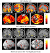 Fig. (3). Group comparisons of patient groups based on baseline diagnosis and one year conversion status using a one-way ANOVA of GM density maps.