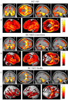 Fig. (2). Group comparisons of healthy control participants and patient groups using a one-way ANOVA of GM density maps.