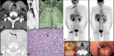 Images in a 41-year-old male patient with tracheal Ewing sarcoma with characteristic EWSR-FLI1 fusion protein. (A–C) Contrast-enhanced CT pulmonary angiography images obtained after intravenous injection of 100 mL of iopamidol (Isovue-370; Bracco) in (A) axial soft-tissue window and (B) axial and (C) sagittal lung windows demonstrate polypoidal intraluminal mass arising from posterior right lateral trachea at the level of thyroid gland (white arrow in A and black arrow in B and C). (D) Cinematic volume-rendered CT angiography image in Pulmonary3D object setting (Siemens Healthineers) demonstrates an intraluminal filling defect (white arrow). (E) Photomicrograph of a tracheal biopsy specimen shows cellular tumor with diffuse, sheetlike distribution of small- to medium-sized round, blue primitive neoplastic cells with scant vacuolated cytoplasm (black arrow), consistent with Ewing sarcoma. (Hematoxylin-eosin stain; original magnification, ×40.) (F–H) Initial staging fluorine 18 (18F) fluorodeoxyglucose (FDG) PET/CT images. (F) Maximum intensity projection, (G) transaxial fused PET/CT, and (H) unenhanced axial CT images with abnormal focus of increased FDG uptake in the neck (black arrow in F) corresponding to the intraluminal soft-tissue tracheal lesion (white arrow in G and H). (I) Restaging 18F-FDG PET/CT maximum intensity projection image shows postsurgical changes following resection of the upper tracheal soft-tissue mass lesion with no residual FDG uptake at the resection site to suggest metabolically active residual or recurrent tumor. Persistent focal uptake at the right alveolar margin is related to dental disease and faint uptake in surgical bed is related to the thyroid tracer uptake. (J) Bronchoscopic image shows pedunculated mass in the upper trachea (white arrow). Source.—Reference 6.
