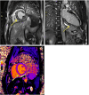 Cardiac MR images in a 21-year-old male patient with filamin C variant–associated cardiomyopathy. Postcontrast T1-weighted images acquired with a 1.5-T MRI scanner in (A) short-axis view and (B) vertical long-axis view demonstrate marked concentric (or “ringlike”) midmyocardial late gadolinium enhancement of the left ventricle (yellow arrows). (C) Native T1 mapping image in short-axis view demonstrates an elevated T1 value (1120 msec). Source.—Reference 5.