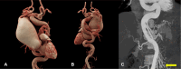 Volume-rendered CT images in the patient show (A) an ascending aortic aneurysm with (B) severe tortuosity of the descending aorta. (C) Coronal maximum intensity projection image shows severe tortuosity and corkscrew appearance of the branches of the superior mesenteric artery (yellow arrow). Source.—Reference 4.