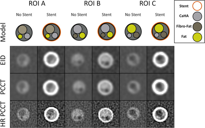 Coronary phantom content and imaging. Each column shows a different region of interest (ROI), with the detailed 5-mm probe content shown in the top row. Cross-sections of the probe at energy-integrating detector (EID; second row), photon-counting CT (PCCT; third row), and high-resolution PCCT (HR-PCCT; fourth row) with and without stents. Window and level for unstented cases was 1600 HU and 300 HU and for stented cases was 1000 HU and 250 HU, respectively.