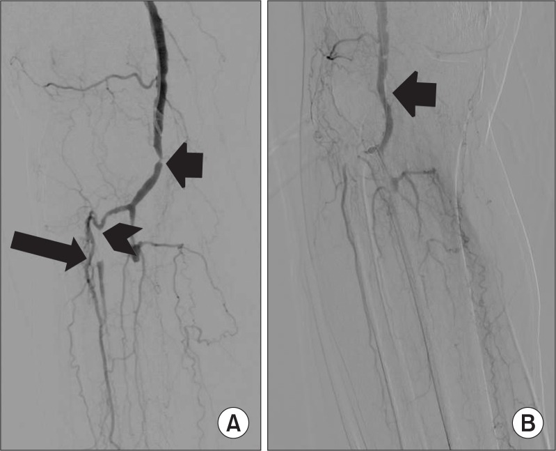 Popliteal-to-Dorsalis Pedis In-Situ Small Saphenous Vein Bypass under ...