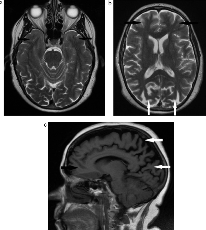 Balint syndrome chronic visual spatial disorder presenting without