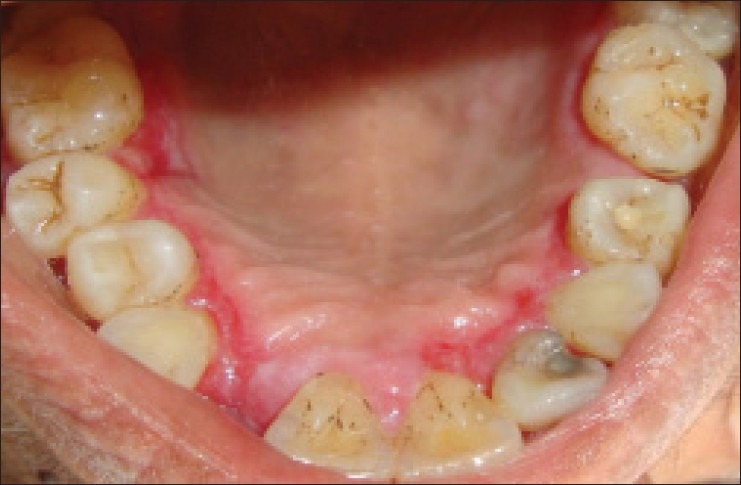 Pemphigus vulgaris presenting as gingival involvement - PMC