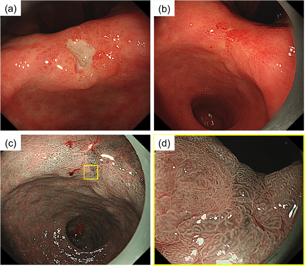 A Case Of Early Gastric Cancer With Metastatic Recurrence Following 