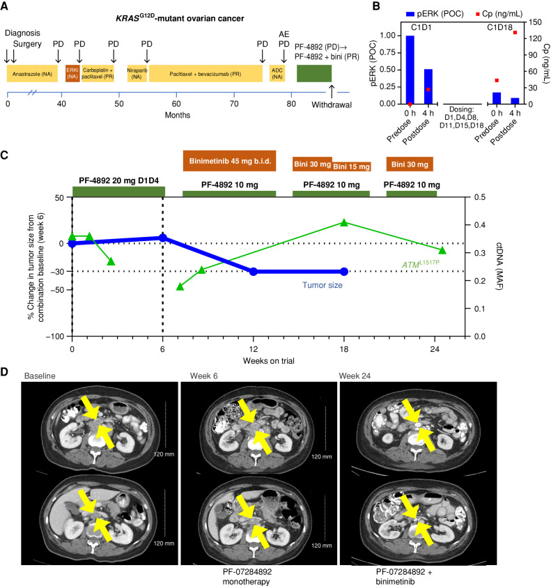 Figure 4. PF-07284892 sensitizes a patient with KRASG12D-mutant ovarian cancer to the MAPK pathway inhibitor binimetinib. A, Prior treatments for metastatic disease included ASN-007 (investigational ERK inhibitor), chemotherapy, niraparib, and SGN-STNV (investigational antibody–drug conjugate). B, Levels of PF-07284892 in plasma (red squares) and pERK in ex vivo CSF1-stimulated peripheral blood monocytes (blue bars), as in Fig. 2D. C, Change in the sum of the longest tumor diameters of target lesions and of ATML1517P in ctDNA over time, as in Fig. 2E. D, Imaging of two abdominal target lesions during study treatment. All treatment-related AEs were grade 1 except for edema (grades 1–2, starting on monotherapy, worsening on the combination, and leading to dose modification), fatigue (grades 2–3), weight gain, diarrhea, and eczema (each grade 2 and resolved by the end of treatment). ADC, antibody–drug conjugate; b.i.d., twice daily; bini, binimetinib; C, cycle; Cp, plasma concentration; D, day; ERKi, ERK inhibitor; MAF, mean allele frequency; NA, not available; PD, progressive disease; PF-4892, PF-07284892; POC, percentage of control.