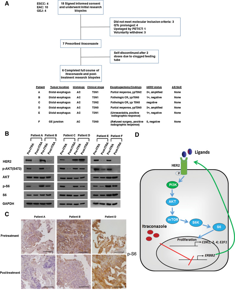 Figure 6. Itraconazole inhibits HER2/AKT signaling in primary tumors from patients with esophageal cancer. A, Top, CONSORT diagram of early phase I trial. Eighteen patients with ESCC, EAC, or gastroesophageal junction cancer signed written informed consent and were enrolled in the trial. Following initial research biopsies but before itraconazole was prescribed, 11 patients screen failed or voluntarily withdrew. Seven patients were prescribed itraconazole, with one patient discontinuing the medication after only 2 doses. Bottom: clinical and pathologic characteristics of the 6 patients who completed the full course of itraconazole. B, Western blot analysis of p-AKT, AKT, p-S6, S6, and HER2 protein in primary tumors from 6 patients with esophageal cancer before and after itraconazole treatment. GAPDH is used as a loading control. C, IHC staining of p-S6 from representative tumor sections of three different patients before (top) and after (bottom) itraconazole treatment. Patients A and B responded while patient D minimally responded. Scale bar, 100 μm. D, Schematic diagram of itraconazole's action in esophageal cancer. HER2 functional activation promotes PI3K/AKT/mTOR/S6 signaling, leading to the upregulation of AKT signaling target genes CDK1, CDK2, CDK4, and E2F1. Itraconazole suppresses this signaling pathway through downregulating ERBB2 mRNA.