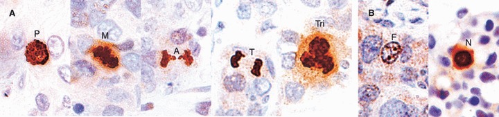 Histological grading of breast cancer on needle core biopsy： the role of immunohistochemical assessm