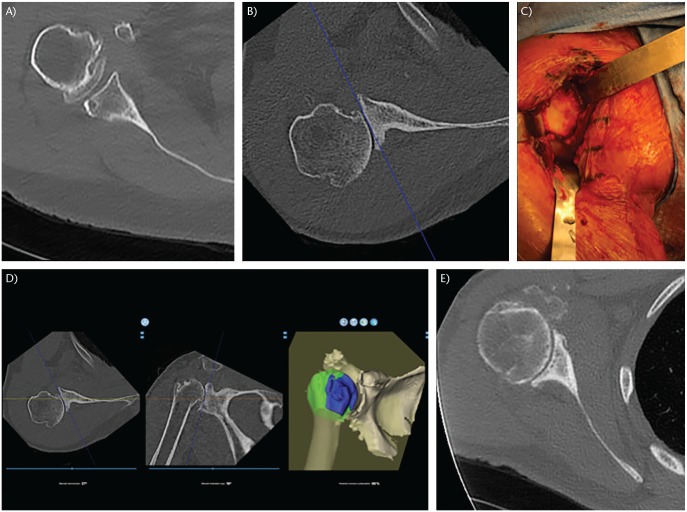 Preoperative glenoid considerations for shoulder arthroplasty: a review ...