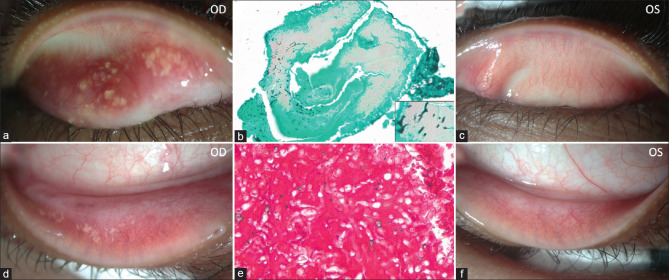 Unilateral conjunctival concretions associated with chronic ...