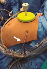 Tourniquet for right hepatectomy tightened and secured with forceps (arrow).