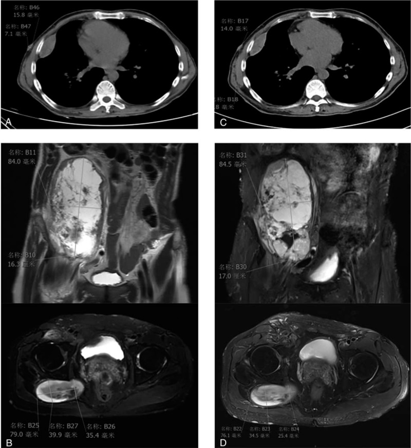 A Novel Tjp1-ros1 Fusion In Malignant Peripheral Nerve Sheath Tumor 