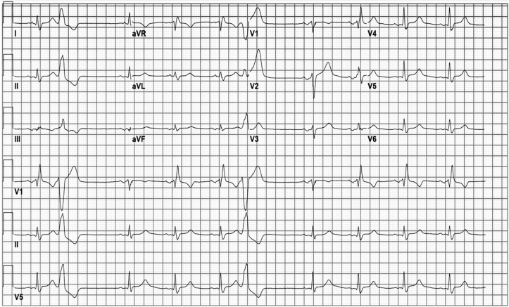 Resolution Of Right Bundle Branch Block After A Premature Ventricular resolution-of-right-bundle-branch-block-after-a-premature-ventricular