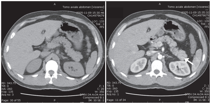 Intrapancreatic Accessory Spleen Mimicking A Pancreatic Endocrine 