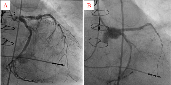 Protected Complex Percutaneous Coronary Intervention And Transcatheter 