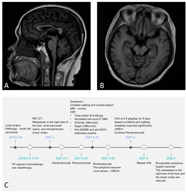 Immune Checkpoint Inhibitor Associated Autoimmune Encephalitis, Rare 