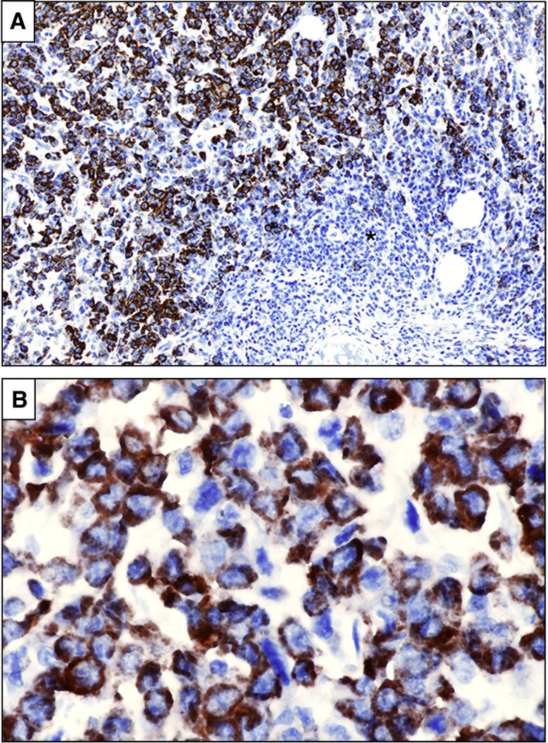 Figure 2. NPM1-mutated myeloid sarcoma (lymph node). A, Partial infiltration of the lymph node (asterisk) by leukemic cells showing aberrant cytoplasmic expression of nucleophosmin (brown; immunoperoxidase; hematoxylin counterstaining; × 100. B, The same field showing NPM1 cytoplasmic positive tumor cells at higher magnification (immunoperoxidase; hematoxylin counterstaining; × 400).